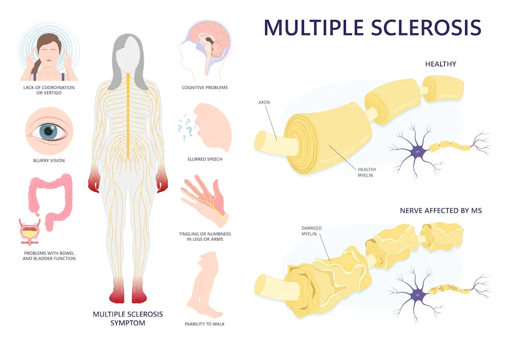 multiple sclerosis