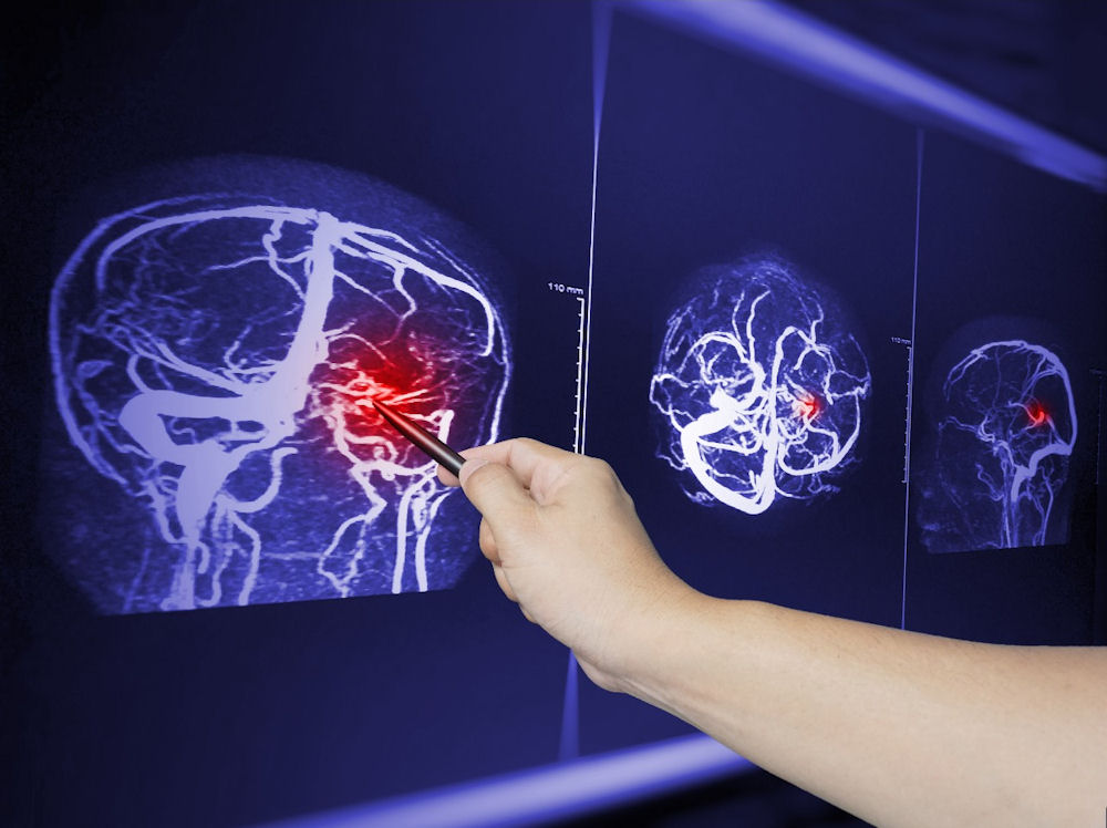 can drugs cause a stroke